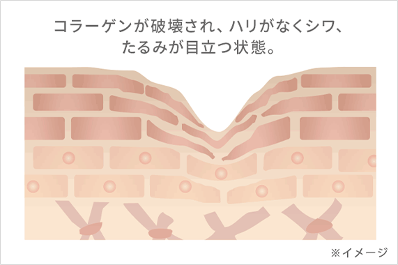 コラーゲンが破壊され、ハリがなくシワ、たるみが目立つ状態。